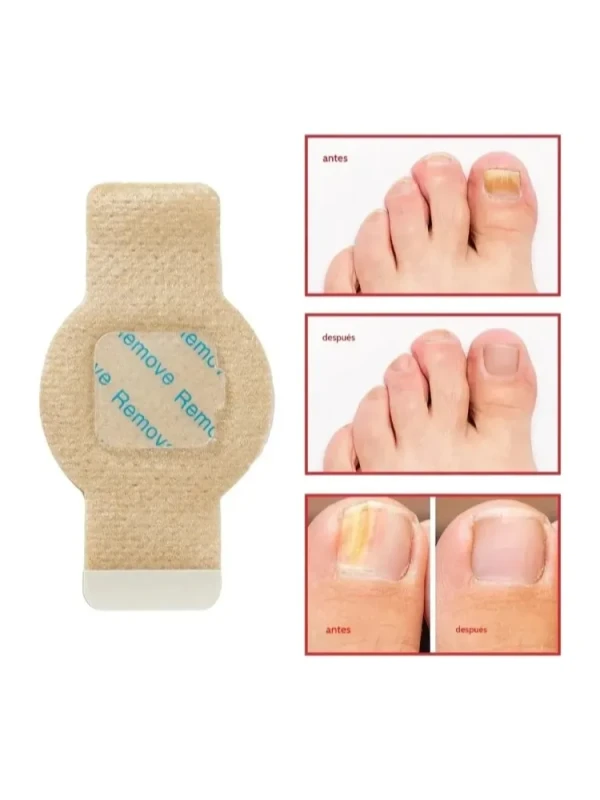 Adesivos Tratamento Fungos Unhas Eficazes